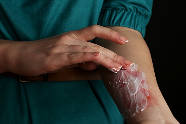 Burns | A Basic Guide To First Aid And CPR | Homesteading Skills
