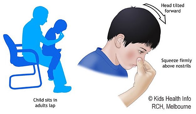 Nosebleeds | A Basic Guide To First Aid And CPR | Homesteading Skills