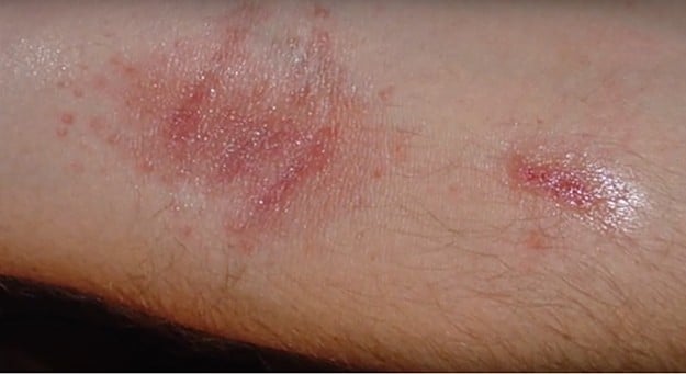 Effects Of Poison Ivy On The Body And Its Treatment | How To Identify Poison Ivy | Homesteading Safety Tips