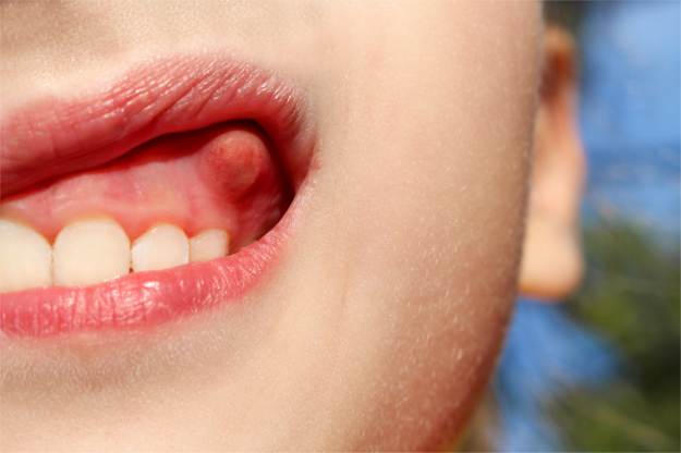 Abscess | Emergency Dental Care Tips For Surviving Health Crisis Off The Grid