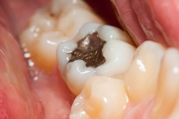 Lost Filling | Emergency Dental Care Tips For Surviving Health Crisis Off The Grid