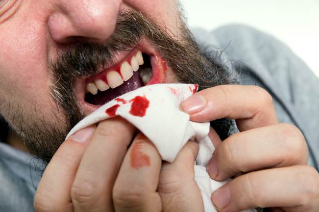  Soft-tissue Injuries | Emergency Dental Care Tips For Surviving Health Crisis Off The Grid