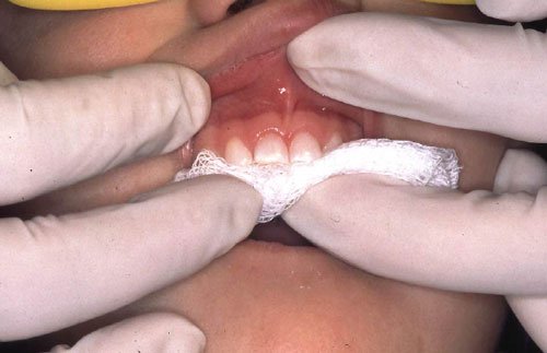 how to pull a tooth how to pull a loose tooth, how to pull a tooth, how to pull out a tooth, how to pull a tooth at home